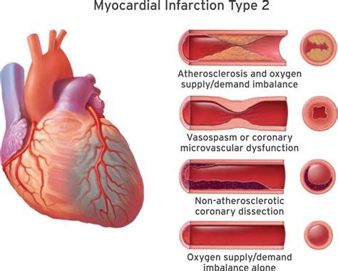 4th Universal Definition Of Myocardial Infarction Explained